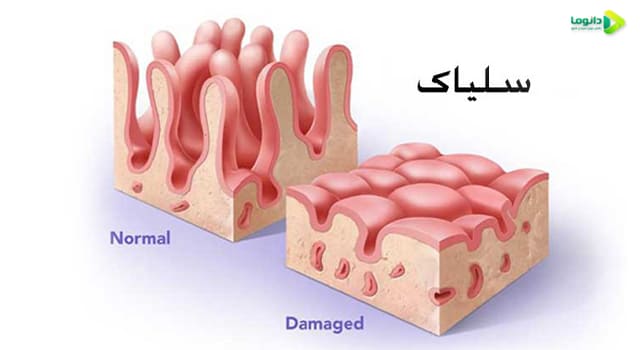 عوارض بیماری سلیاک