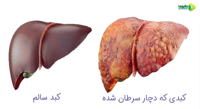 علائم سرطان کبد