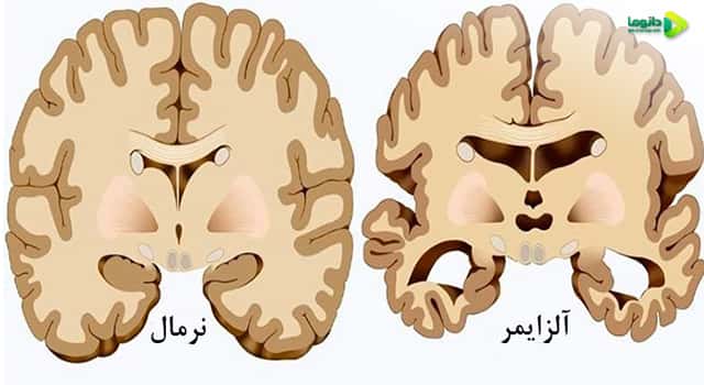 تشخیص آلزایمر