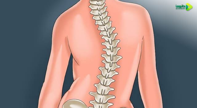 درمان اسکولیوز
