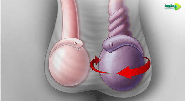 علل پیچ خوردگی بیضه