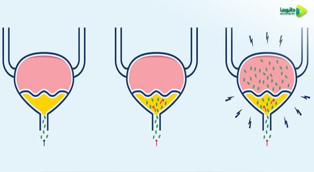 پیشگیری التهاب مثانه