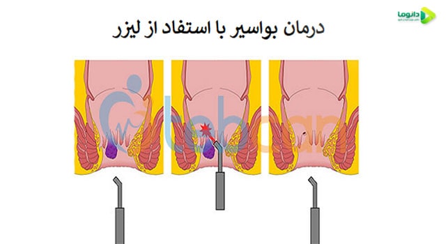 درمان بواسیر در دختران مجرد