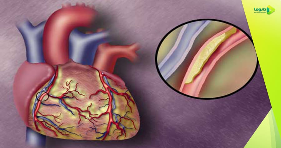 سکته قلبی چیست