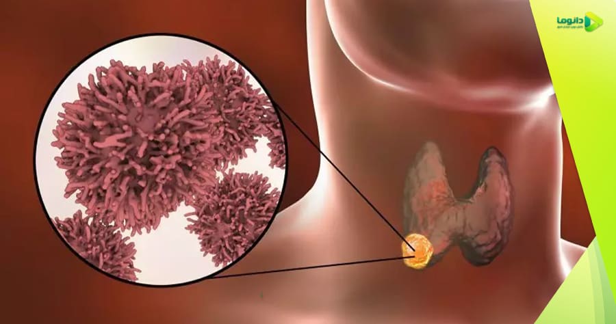 سرطان تیروئید چیست؟