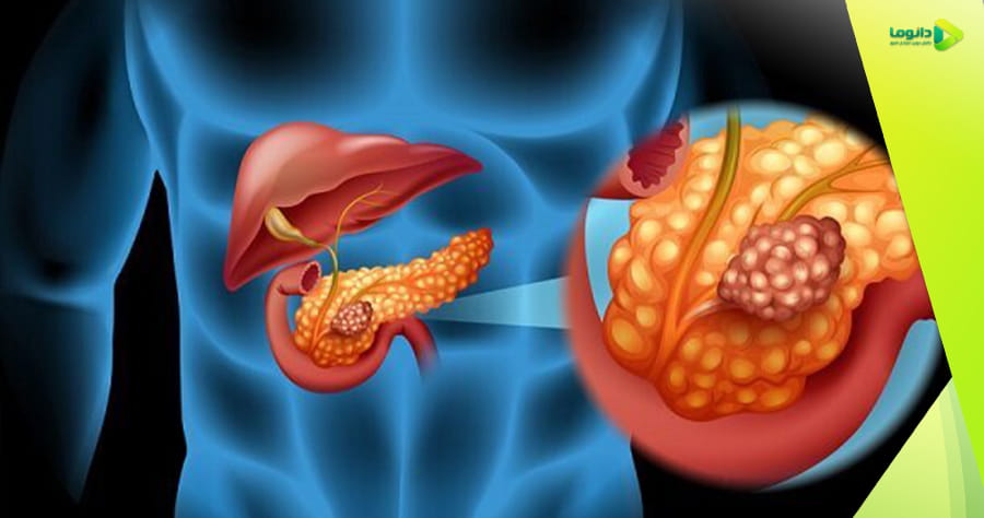 سرطان لوزالمعده یا پانکراس