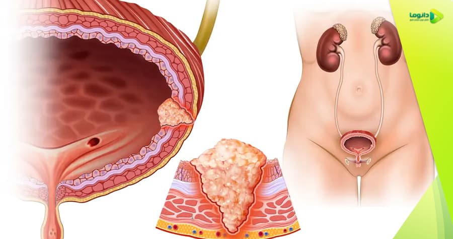 سرطان مثانه چیست؟