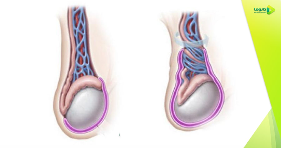 بیماری پیچ خوردگی بیضه