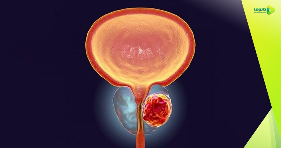 بیماری پروستاتیت
