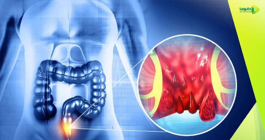 درمان بواسیر در دختران